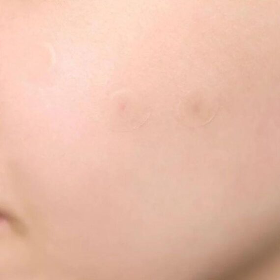 SKIN1004: Spot Cover Patch