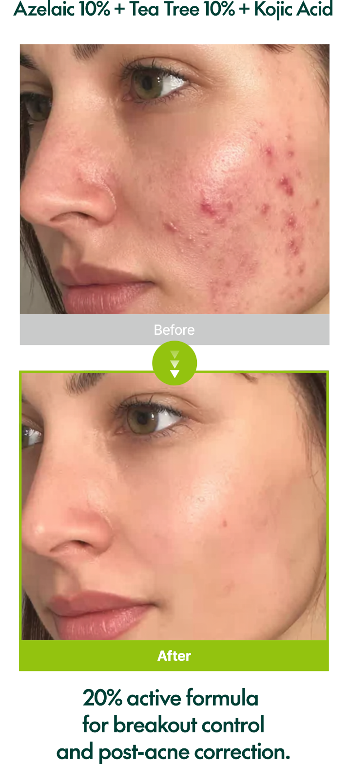 Purito SEOUL: Azelaic Acid 10 Kojic Tea Tree Serum